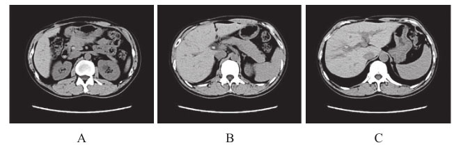 图2 上腹部CT：肝右叶胆管结石及胆总管结石.jpg